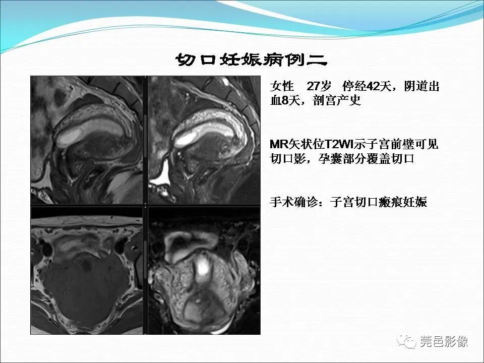 影像PPT - 【病例】输卵管妊娠破裂1例B超及CT影像-28