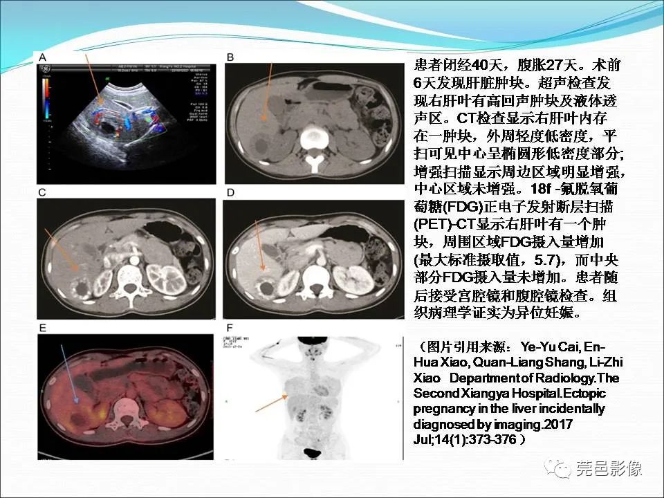 影像PPT - 【病例】输卵管妊娠破裂1例B超及CT影像-30