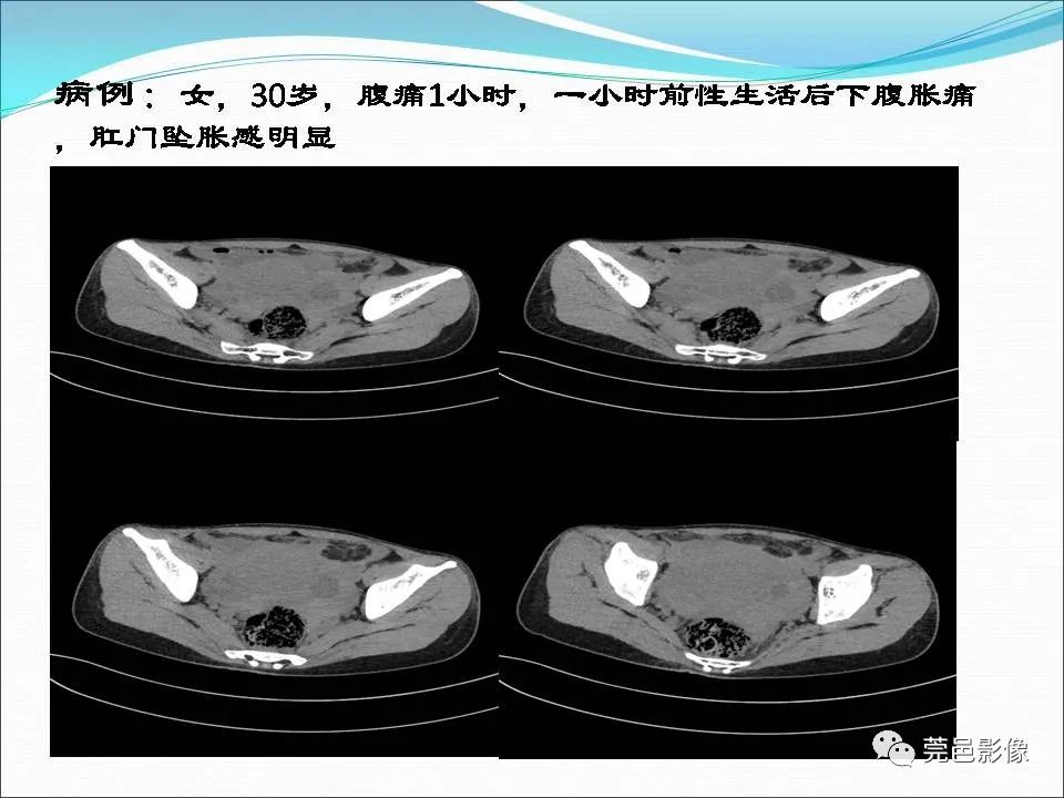 影像PPT - 【病例】输卵管妊娠破裂1例B超及CT影像-33
