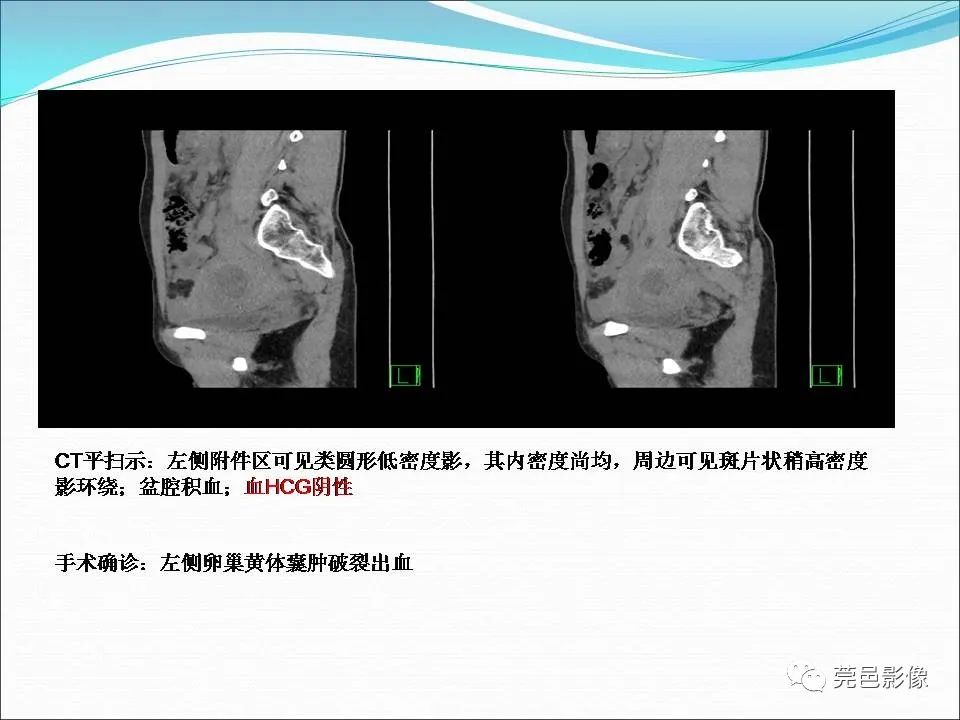 影像PPT - 【病例】输卵管妊娠破裂1例B超及CT影像-34