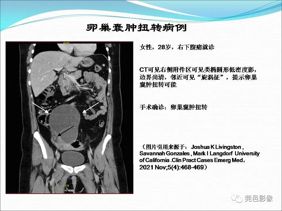 影像PPT - 【病例】输卵管妊娠破裂1例B超及CT影像-35