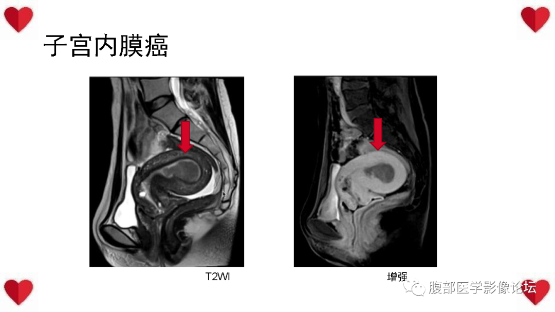 影像PPT - 【病例】子宫内膜样癌1例CT及MR影像-43
