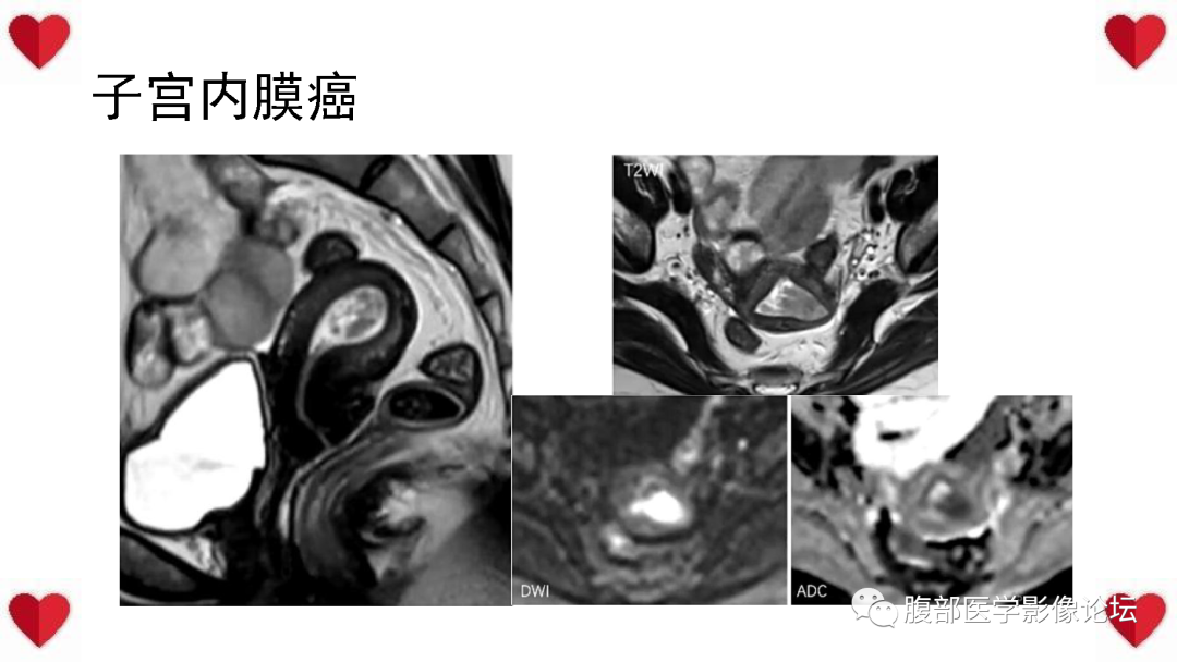 影像PPT - 【病例】子宫内膜样癌1例CT及MR影像-44