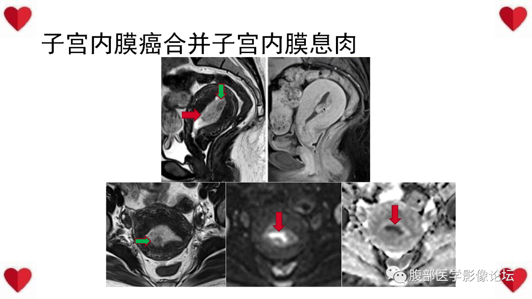 影像PPT - 【病例】子宫内膜样癌1例CT及MR影像-45