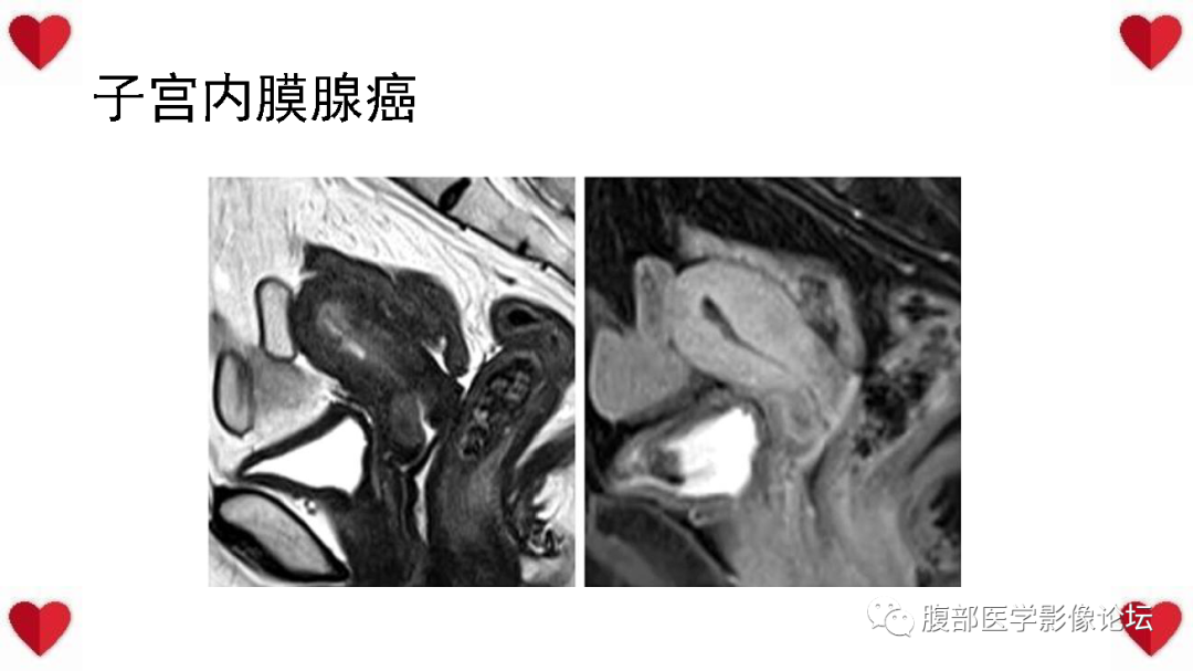 影像PPT - 【病例】子宫内膜样癌1例CT及MR影像-46