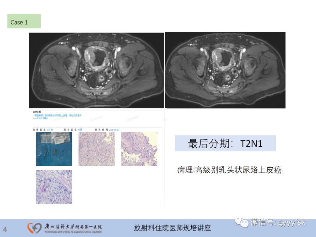 影像PPT - 【PPT】膀胱癌影像诊断、分期及鉴别诊断-5