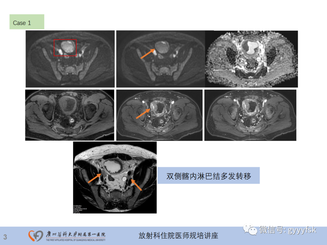 影像PPT - 【PPT】膀胱癌影像诊断、分期及鉴别诊断-4