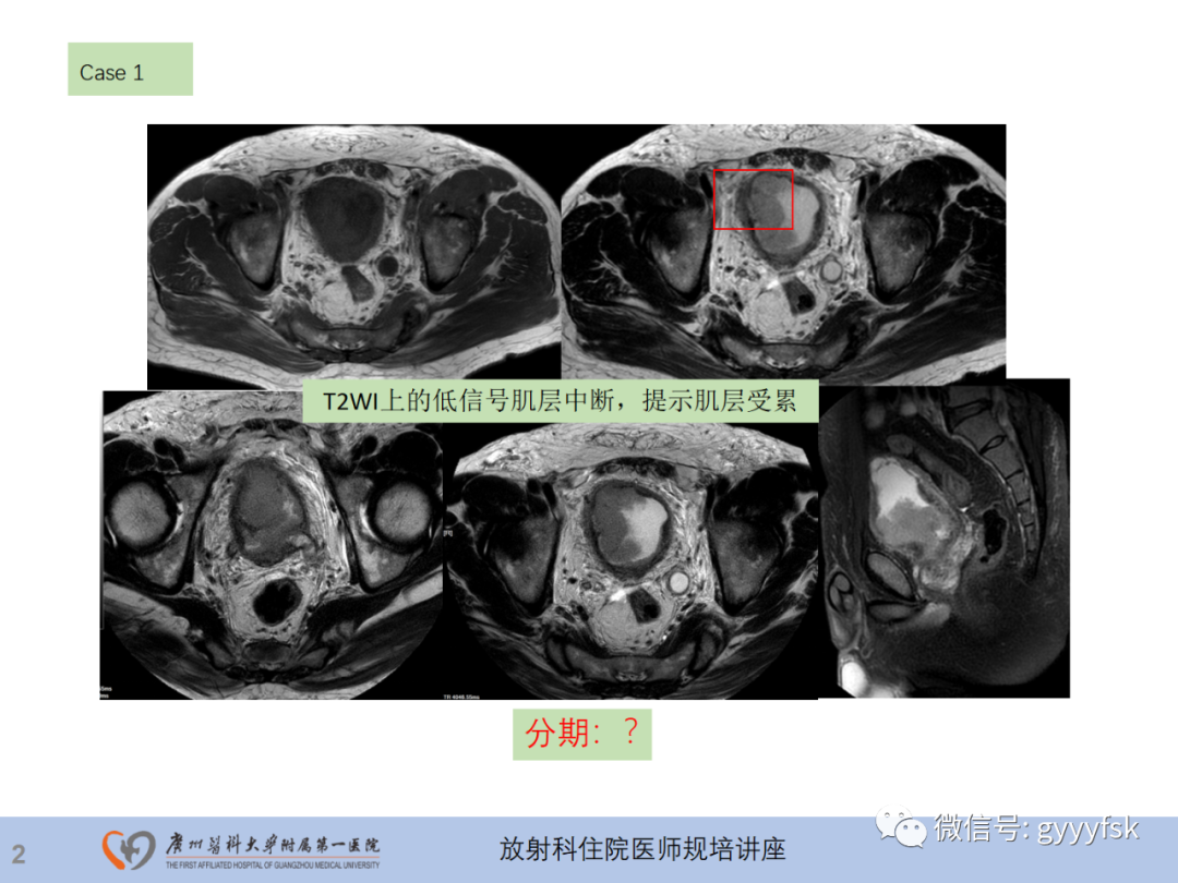 影像PPT - 【PPT】膀胱癌影像诊断、分期及鉴别诊断-3
