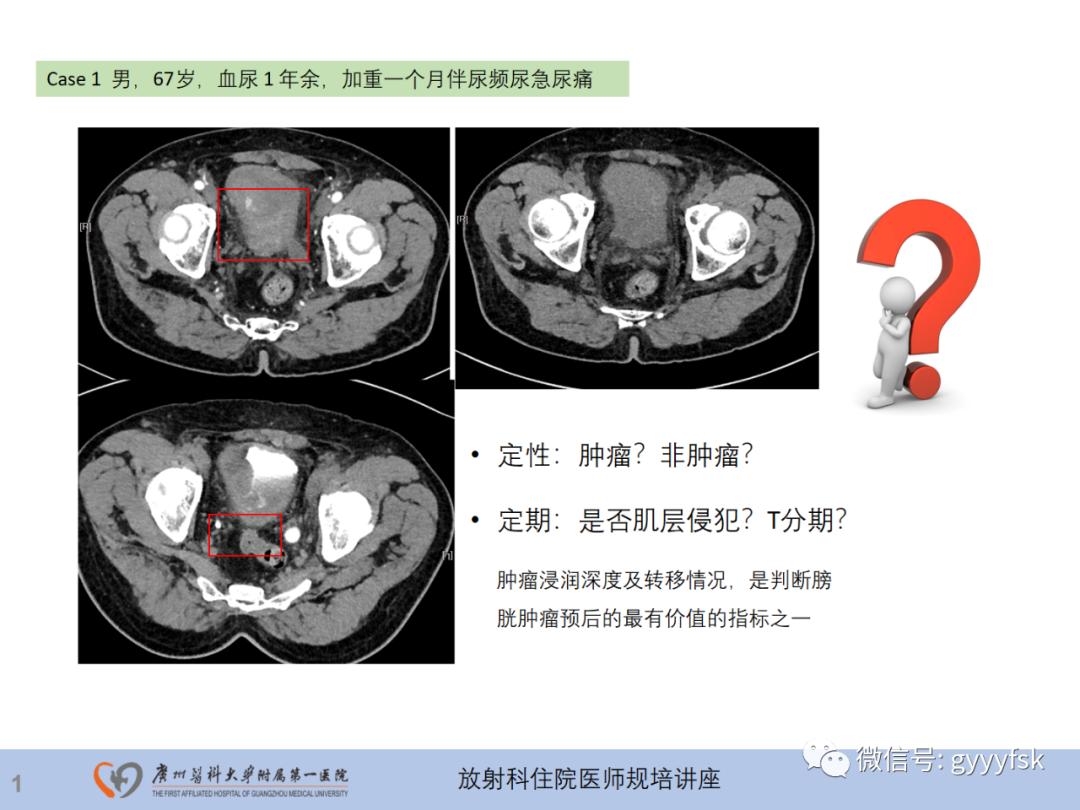 影像PPT - 【PPT】膀胱癌影像诊断、分期及鉴别诊断-2