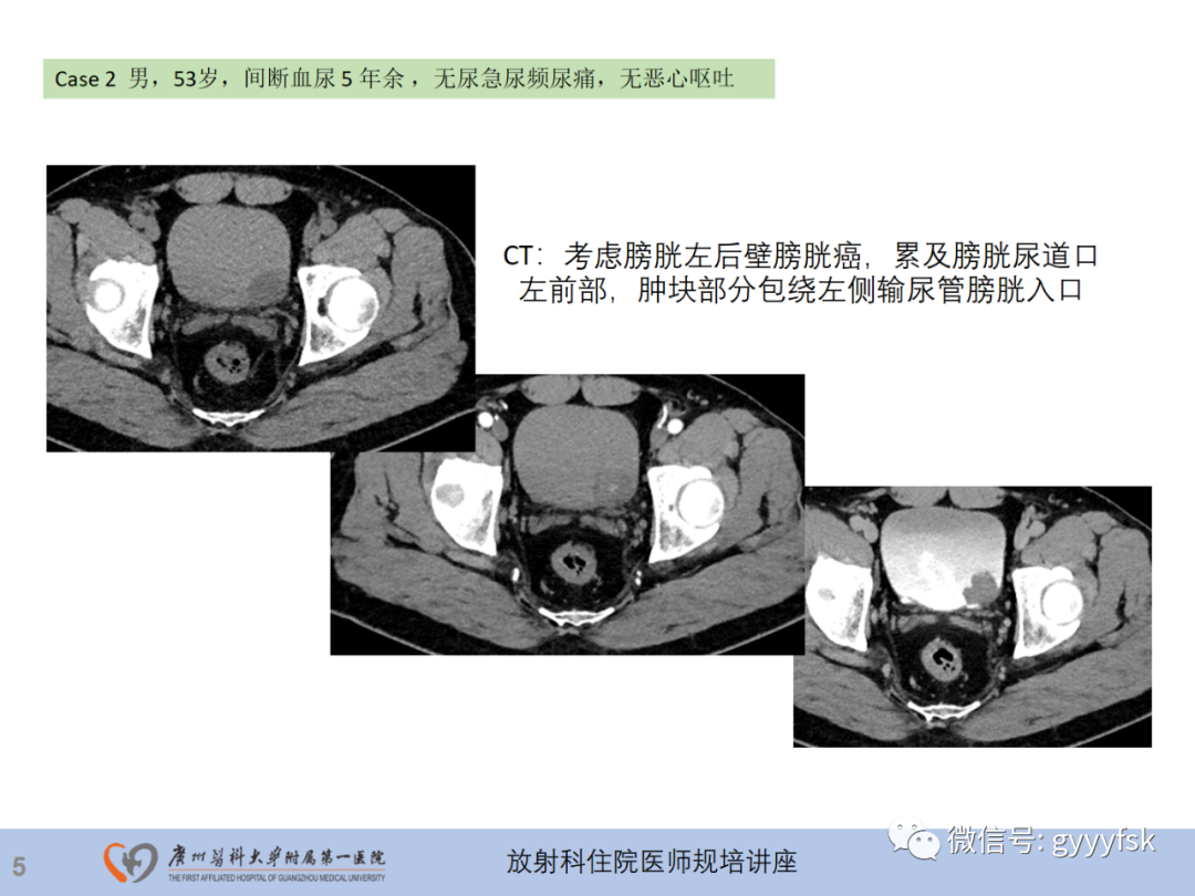 影像PPT - 【PPT】膀胱癌影像诊断、分期及鉴别诊断-6