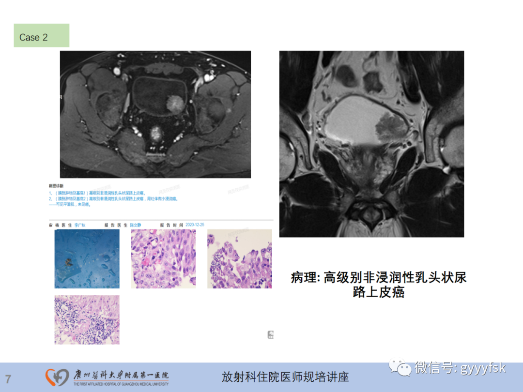 影像PPT - 【PPT】膀胱癌影像诊断、分期及鉴别诊断-8