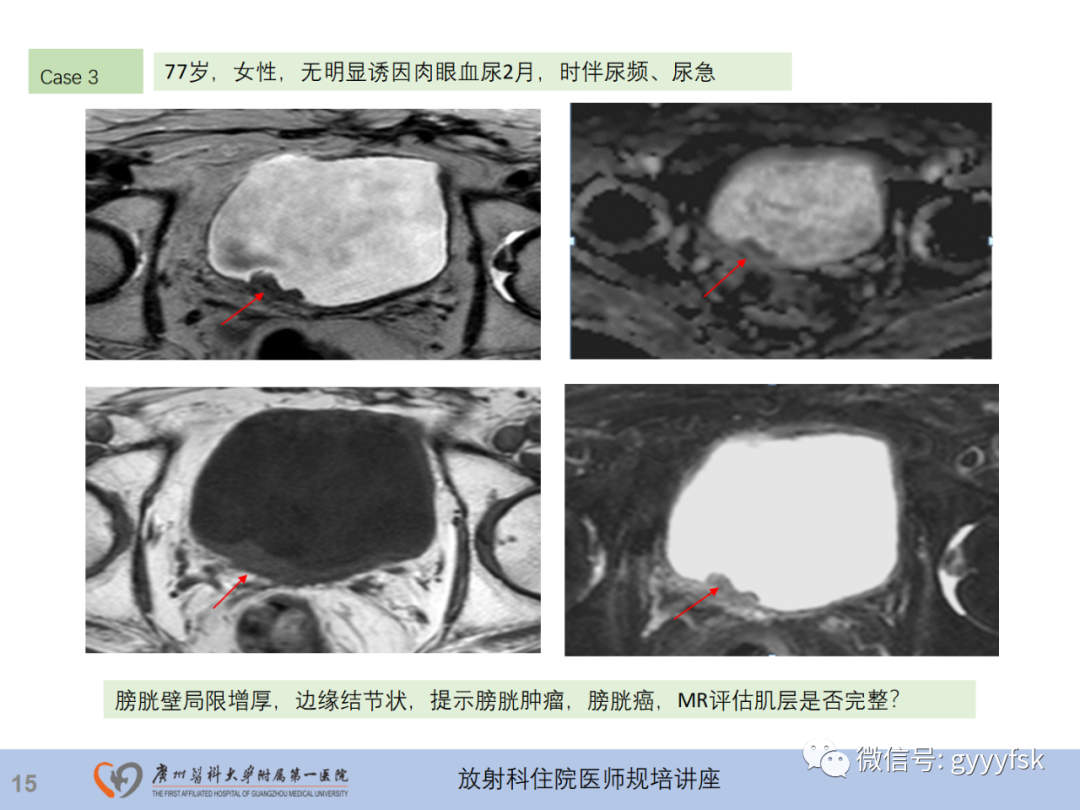 影像PPT - 【PPT】膀胱癌影像诊断、分期及鉴别诊断-16
