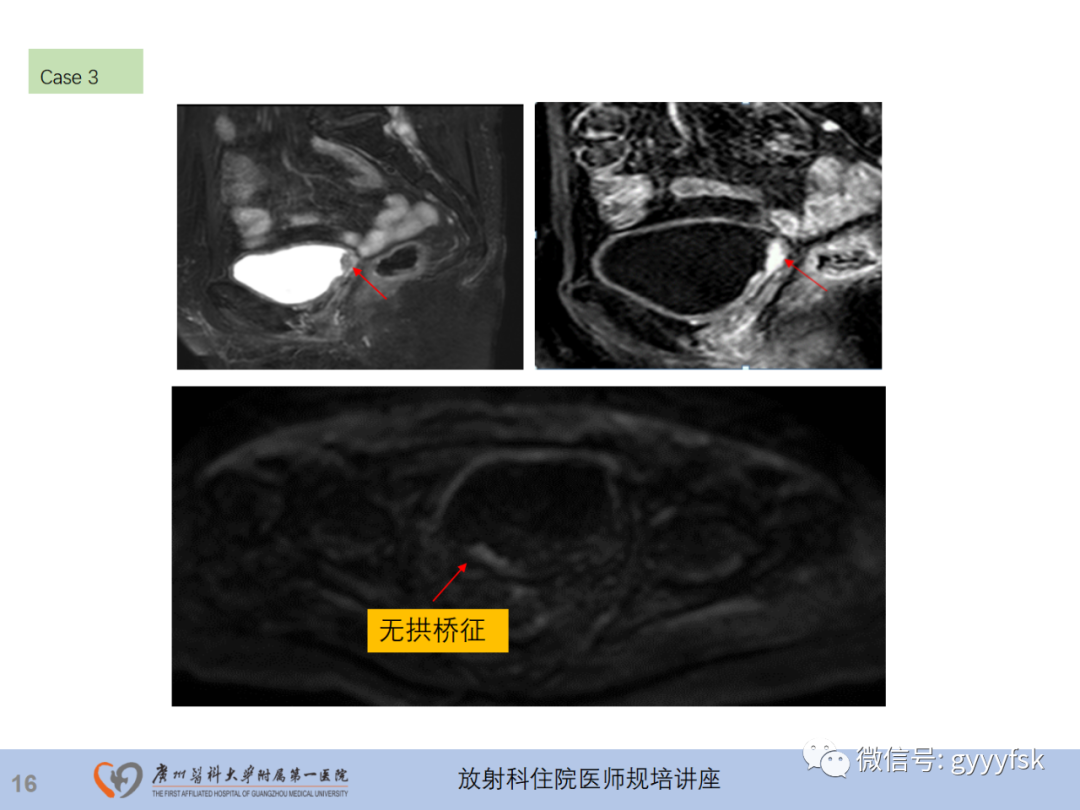 影像PPT - 【PPT】膀胱癌影像诊断、分期及鉴别诊断-17