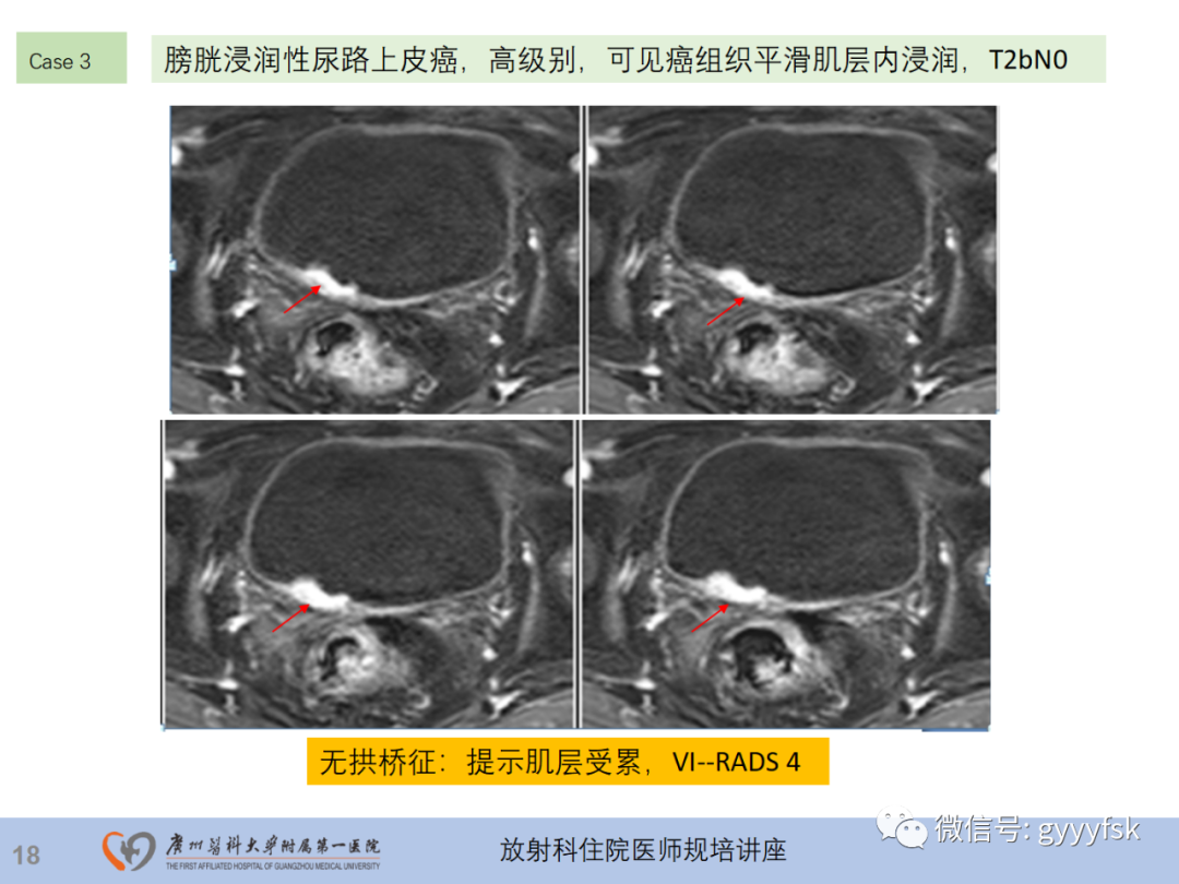 影像PPT - 【PPT】膀胱癌影像诊断、分期及鉴别诊断-19