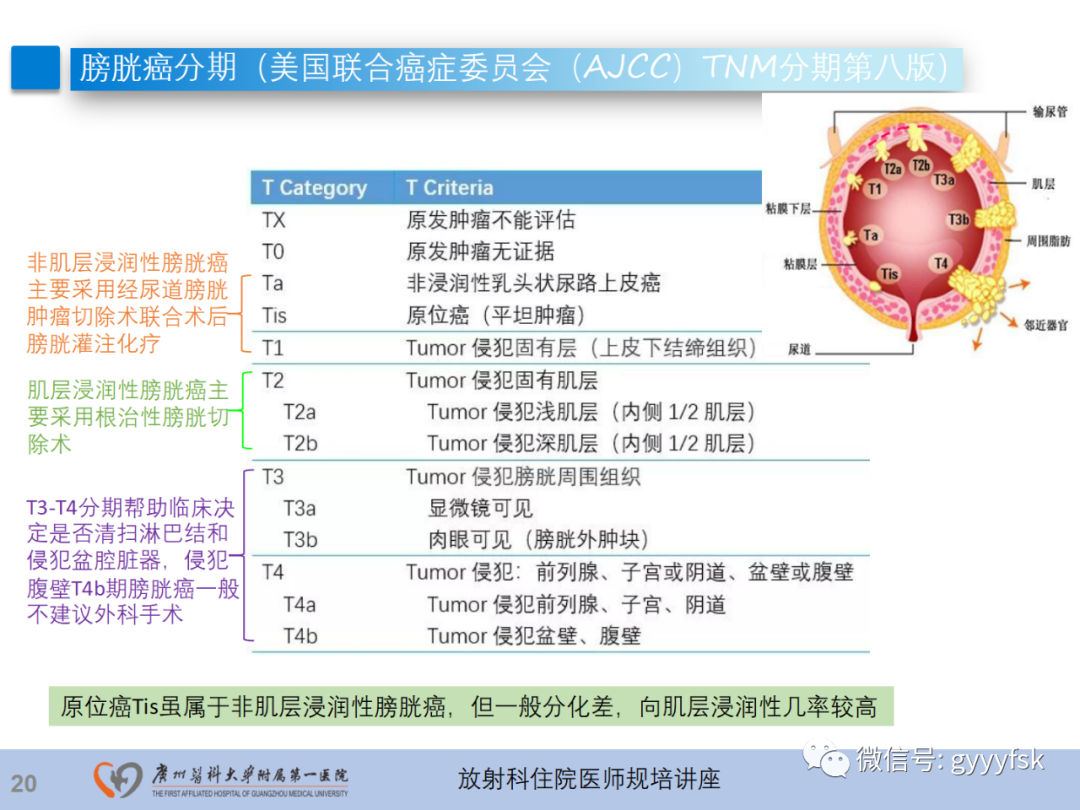 影像PPT - 【PPT】膀胱癌影像诊断、分期及鉴别诊断-21
