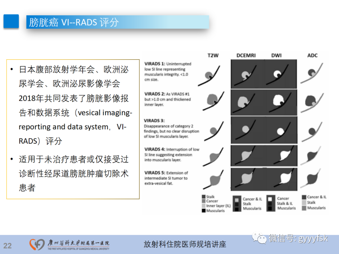 影像PPT - 【PPT】膀胱癌影像诊断、分期及鉴别诊断-23
