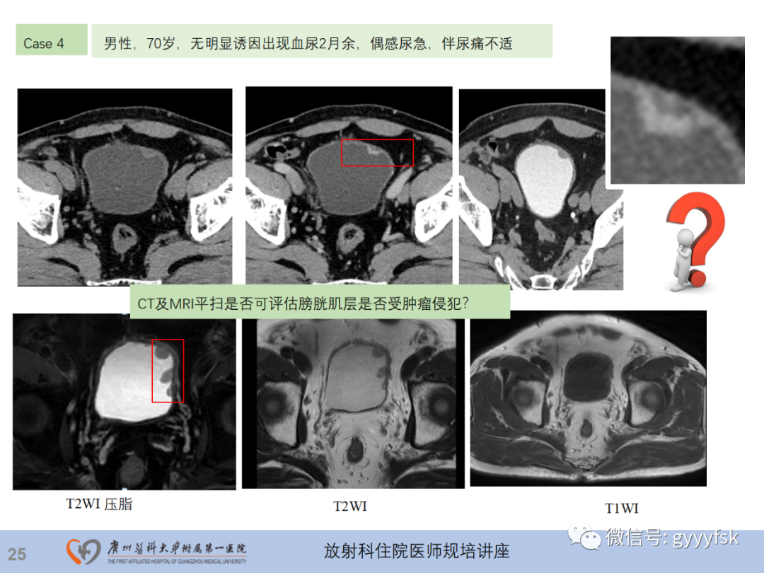 影像PPT - 【PPT】膀胱癌影像诊断、分期及鉴别诊断-26