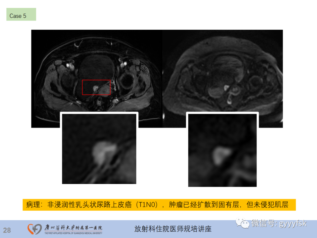 影像PPT - 【PPT】膀胱癌影像诊断、分期及鉴别诊断-29