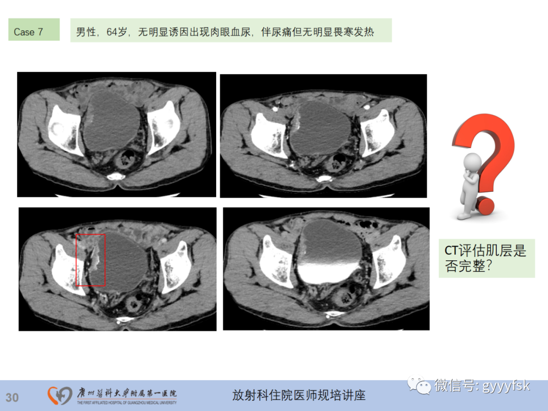 影像PPT - 【PPT】膀胱癌影像诊断、分期及鉴别诊断-31