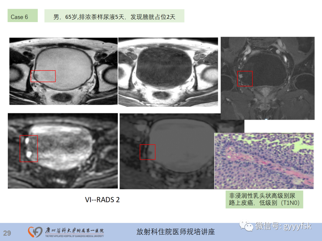 影像PPT - 【PPT】膀胱癌影像诊断、分期及鉴别诊断-30