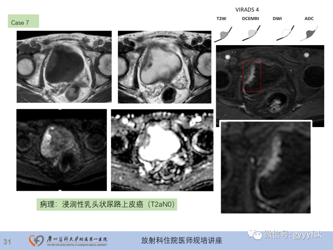 影像PPT - 【PPT】膀胱癌影像诊断、分期及鉴别诊断-32