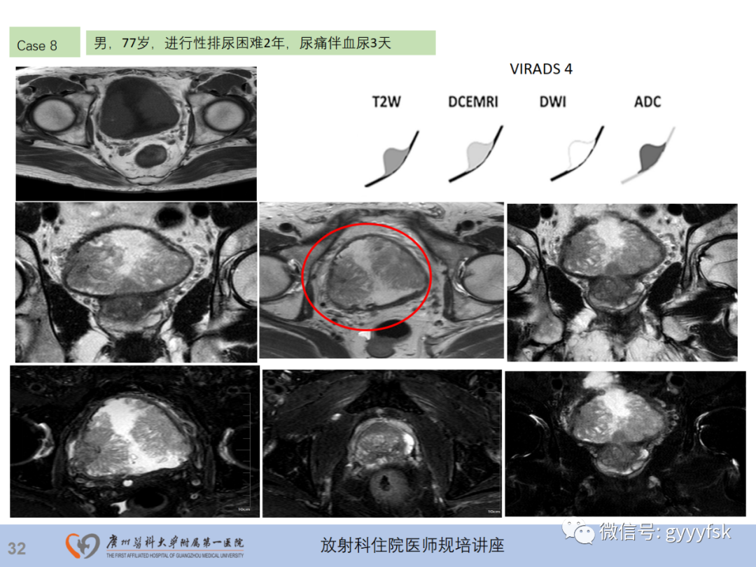影像PPT - 【PPT】膀胱癌影像诊断、分期及鉴别诊断-33