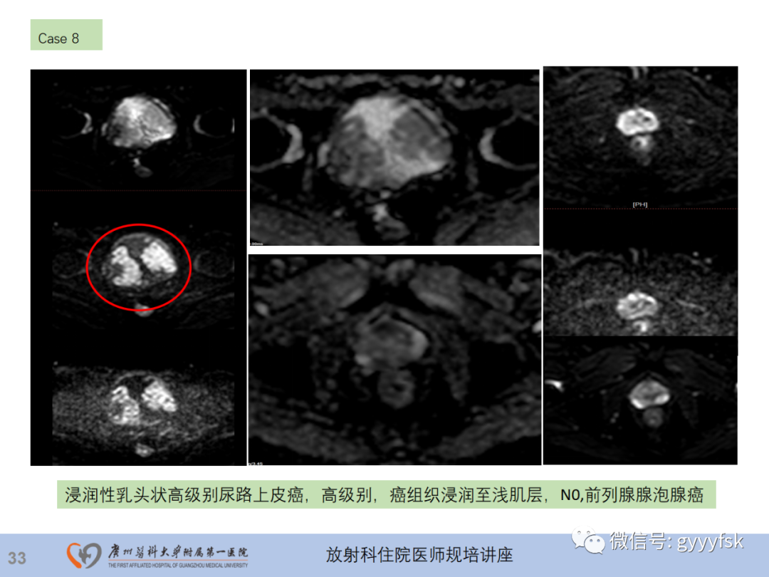 影像PPT - 【PPT】膀胱癌影像诊断、分期及鉴别诊断-34