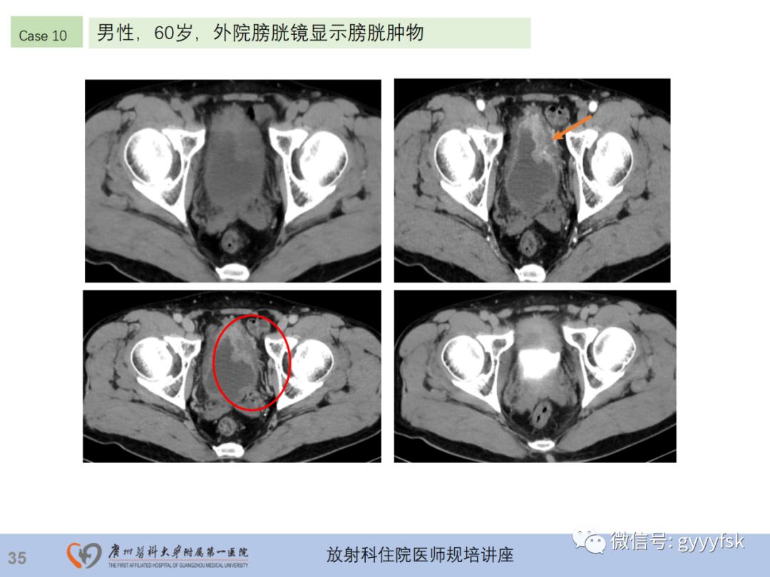 影像PPT - 【PPT】膀胱癌影像诊断、分期及鉴别诊断-36