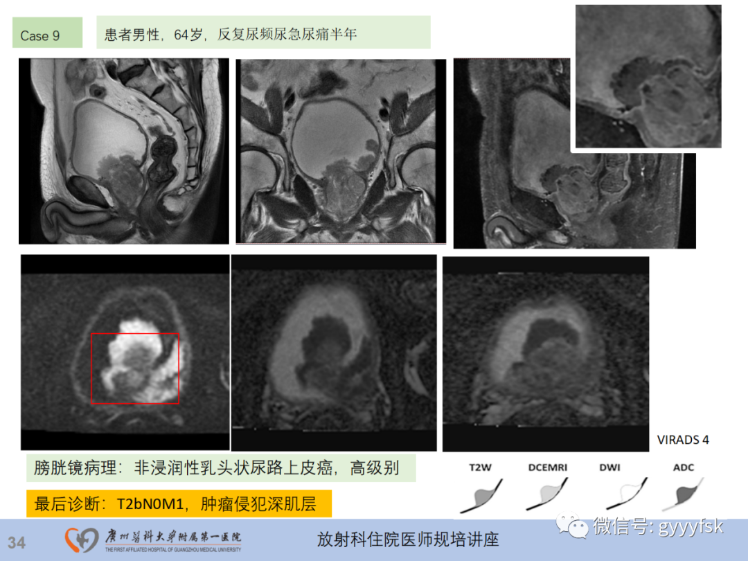 影像PPT - 【PPT】膀胱癌影像诊断、分期及鉴别诊断-35