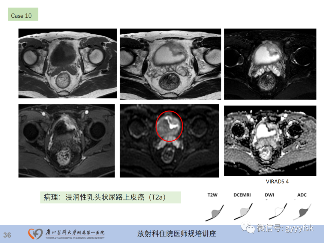 影像PPT - 【PPT】膀胱癌影像诊断、分期及鉴别诊断-37