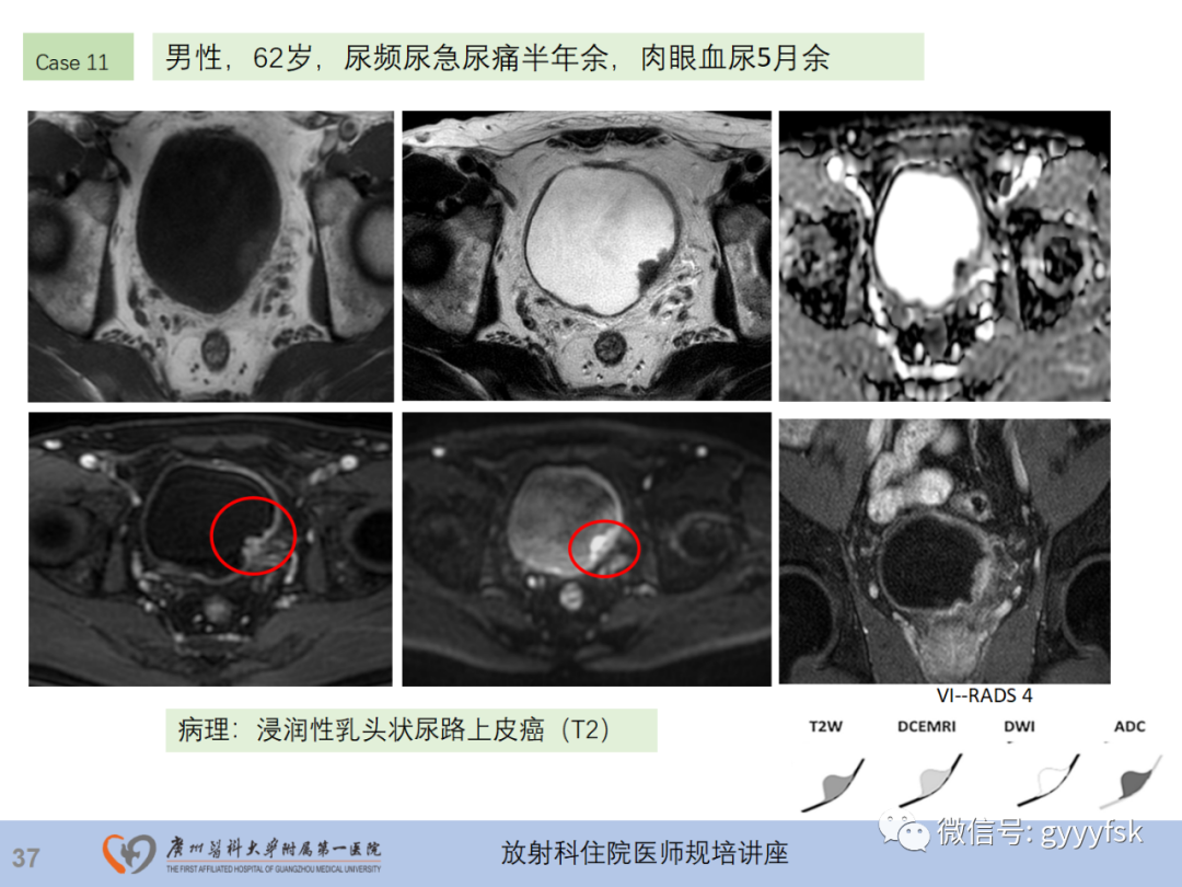 影像PPT - 【PPT】膀胱癌影像诊断、分期及鉴别诊断-38
