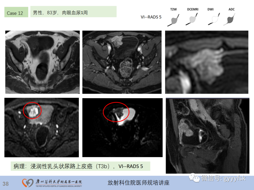 影像PPT - 【PPT】膀胱癌影像诊断、分期及鉴别诊断-39