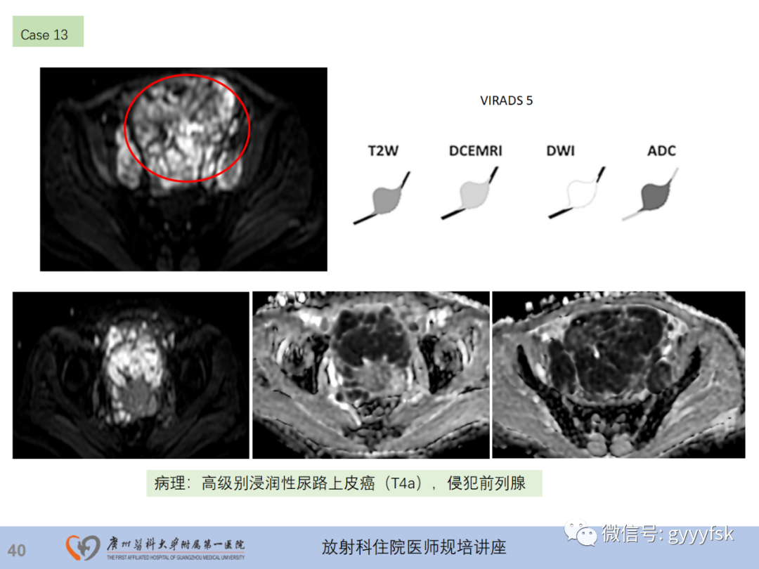 影像PPT - 【PPT】膀胱癌影像诊断、分期及鉴别诊断-41