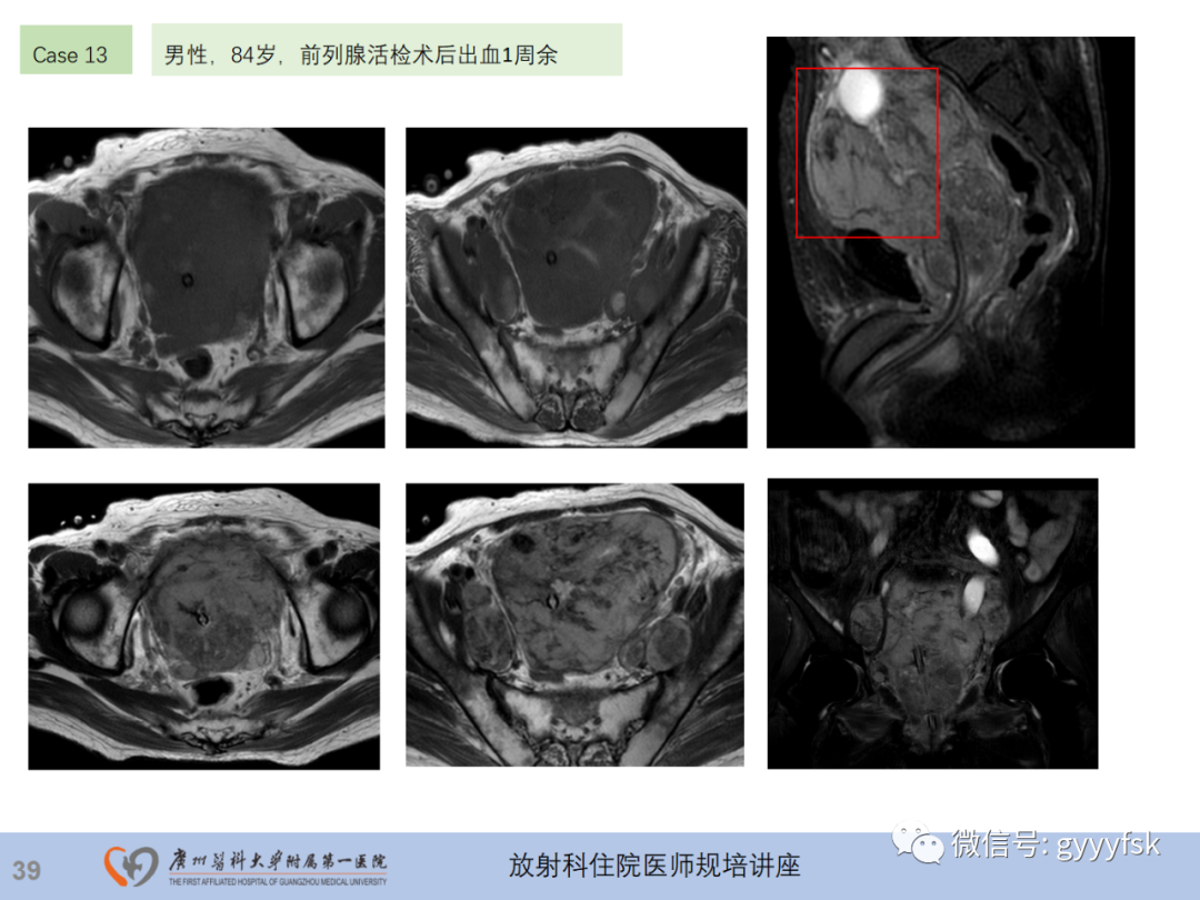 影像PPT - 【PPT】膀胱癌影像诊断、分期及鉴别诊断-40