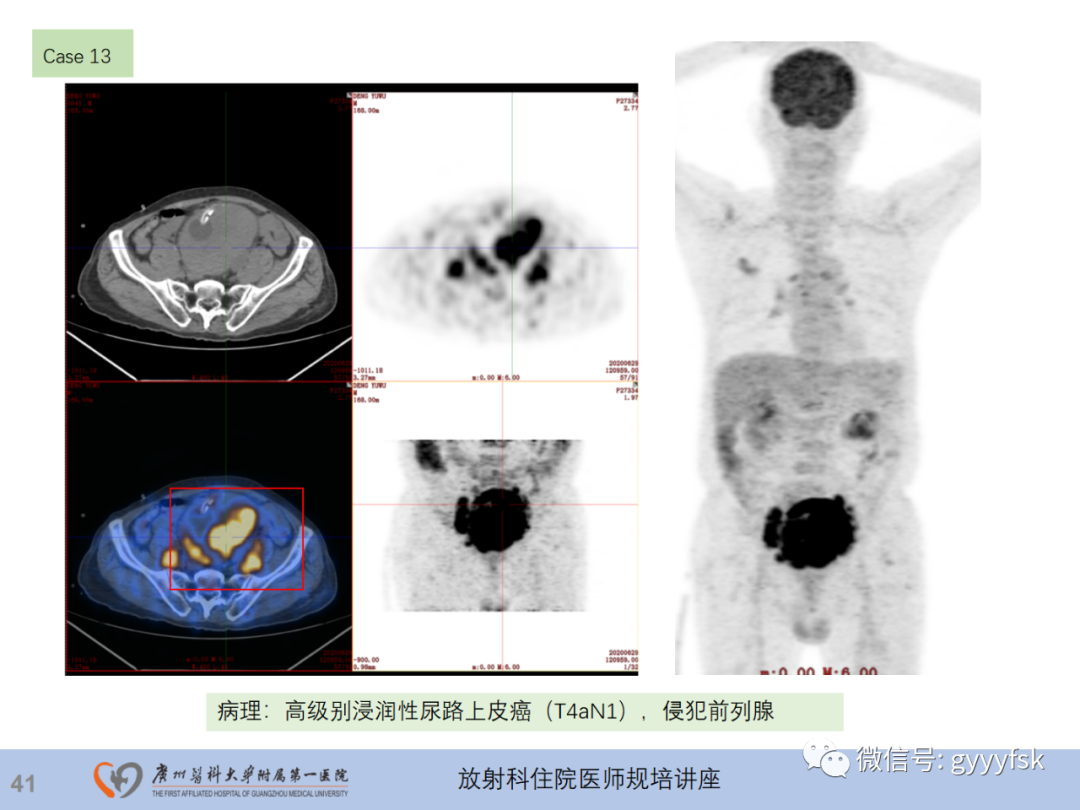 影像PPT - 【PPT】膀胱癌影像诊断、分期及鉴别诊断-42