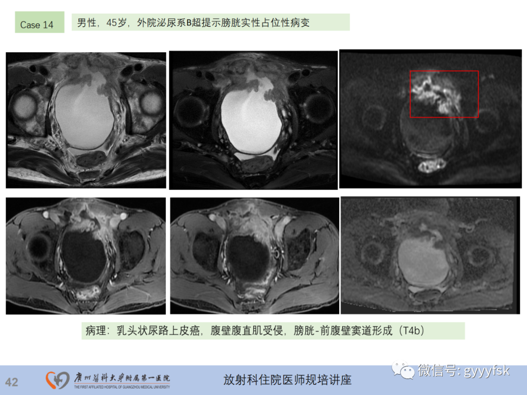 影像PPT - 【PPT】膀胱癌影像诊断、分期及鉴别诊断-43