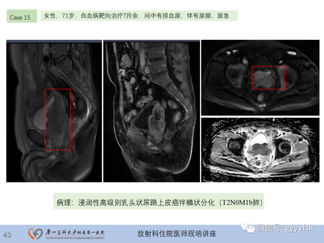 影像PPT - 【PPT】膀胱癌影像诊断、分期及鉴别诊断-44