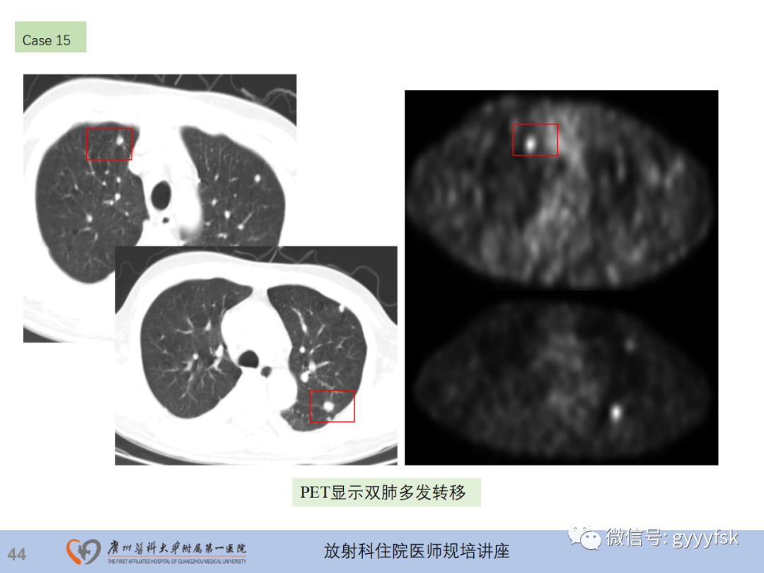 影像PPT - 【PPT】膀胱癌影像诊断、分期及鉴别诊断-45