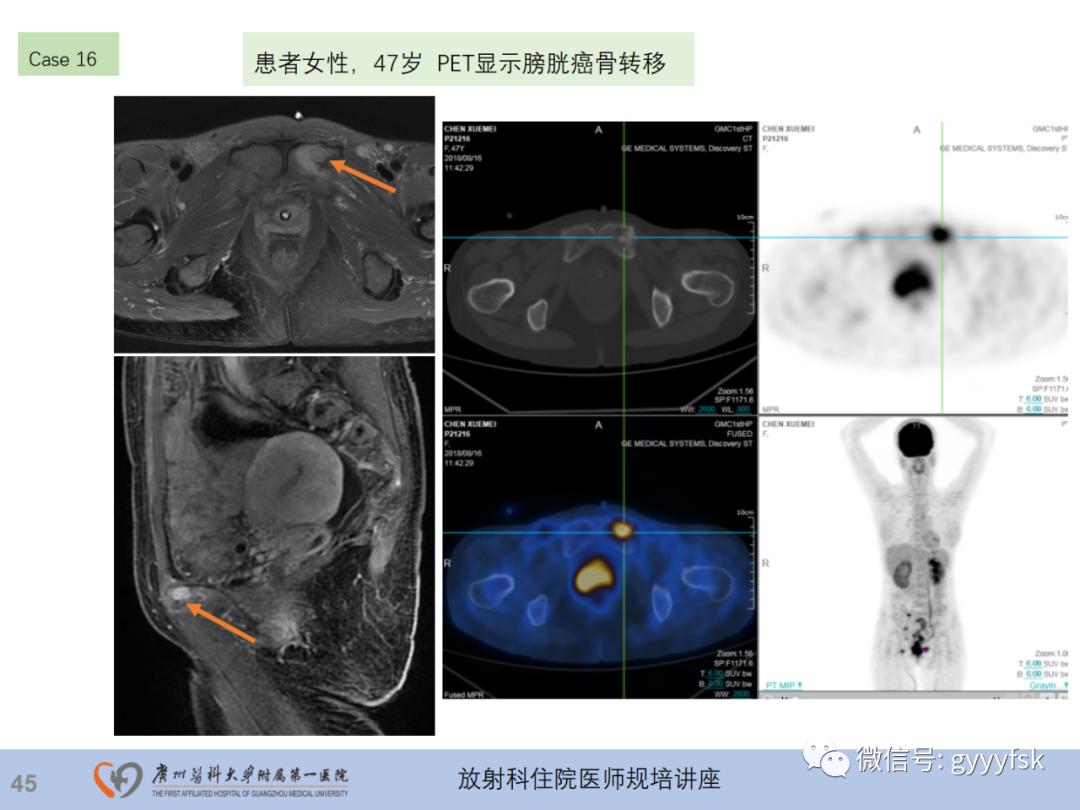 影像PPT - 【PPT】膀胱癌影像诊断、分期及鉴别诊断-46