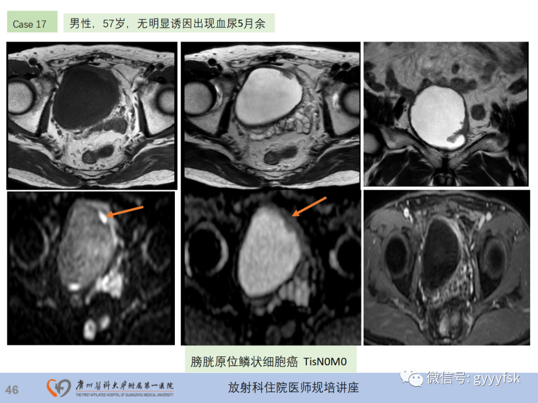 影像PPT - 【PPT】膀胱癌影像诊断、分期及鉴别诊断-47