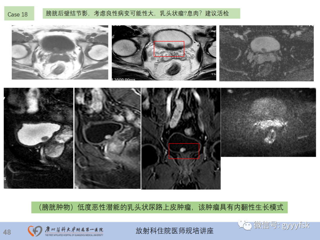 影像PPT - 【PPT】膀胱癌影像诊断、分期及鉴别诊断-49