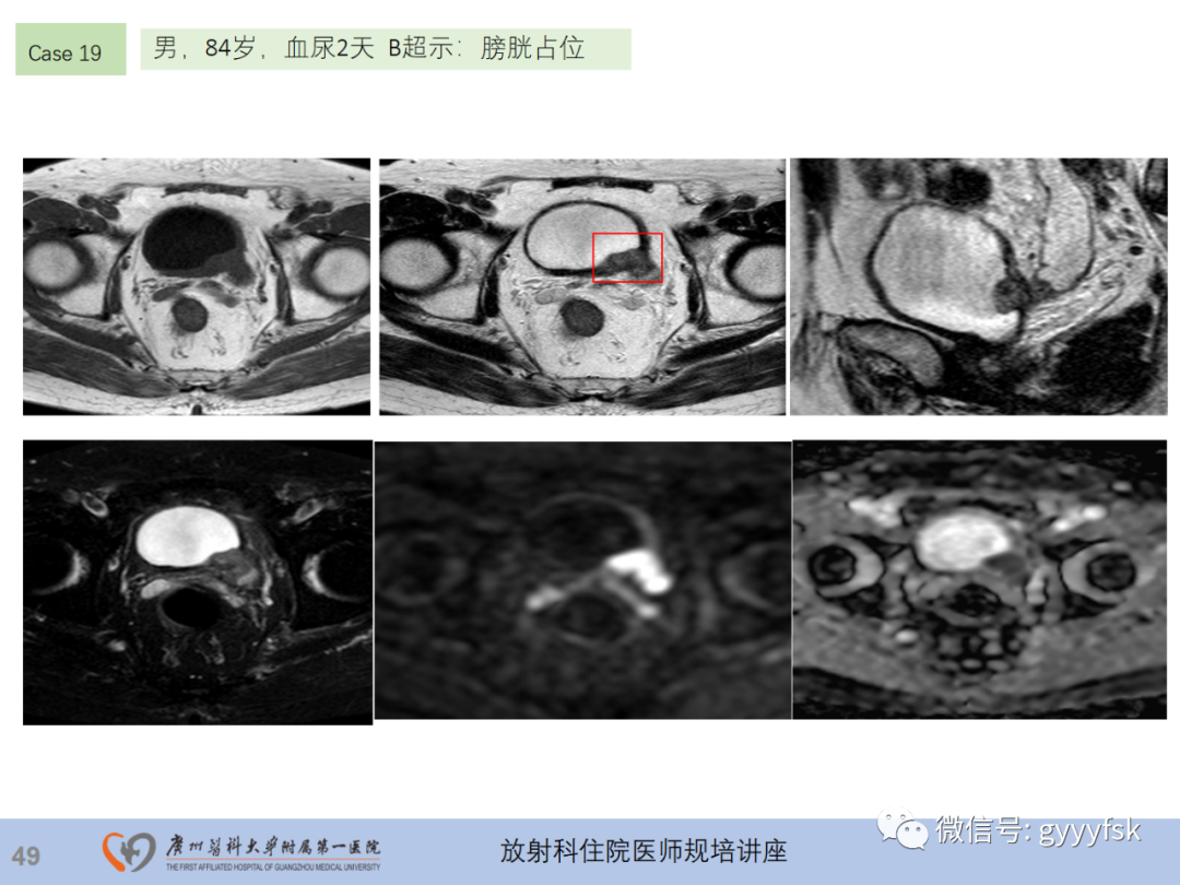 影像PPT - 【PPT】膀胱癌影像诊断、分期及鉴别诊断-50