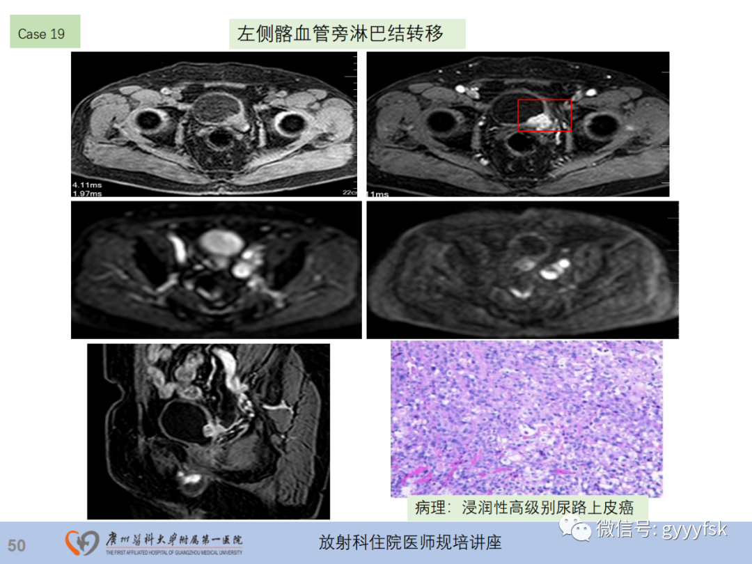 影像PPT - 【PPT】膀胱癌影像诊断、分期及鉴别诊断-51