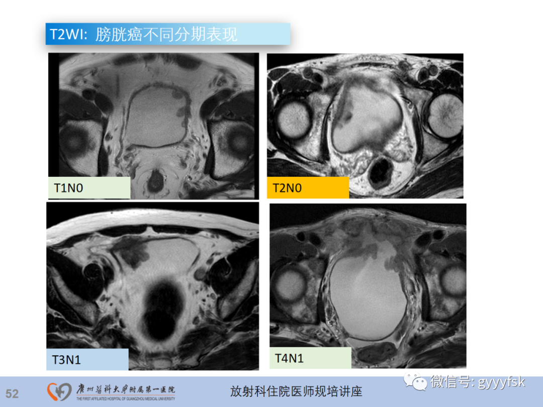 影像PPT - 【PPT】膀胱癌影像诊断、分期及鉴别诊断-53