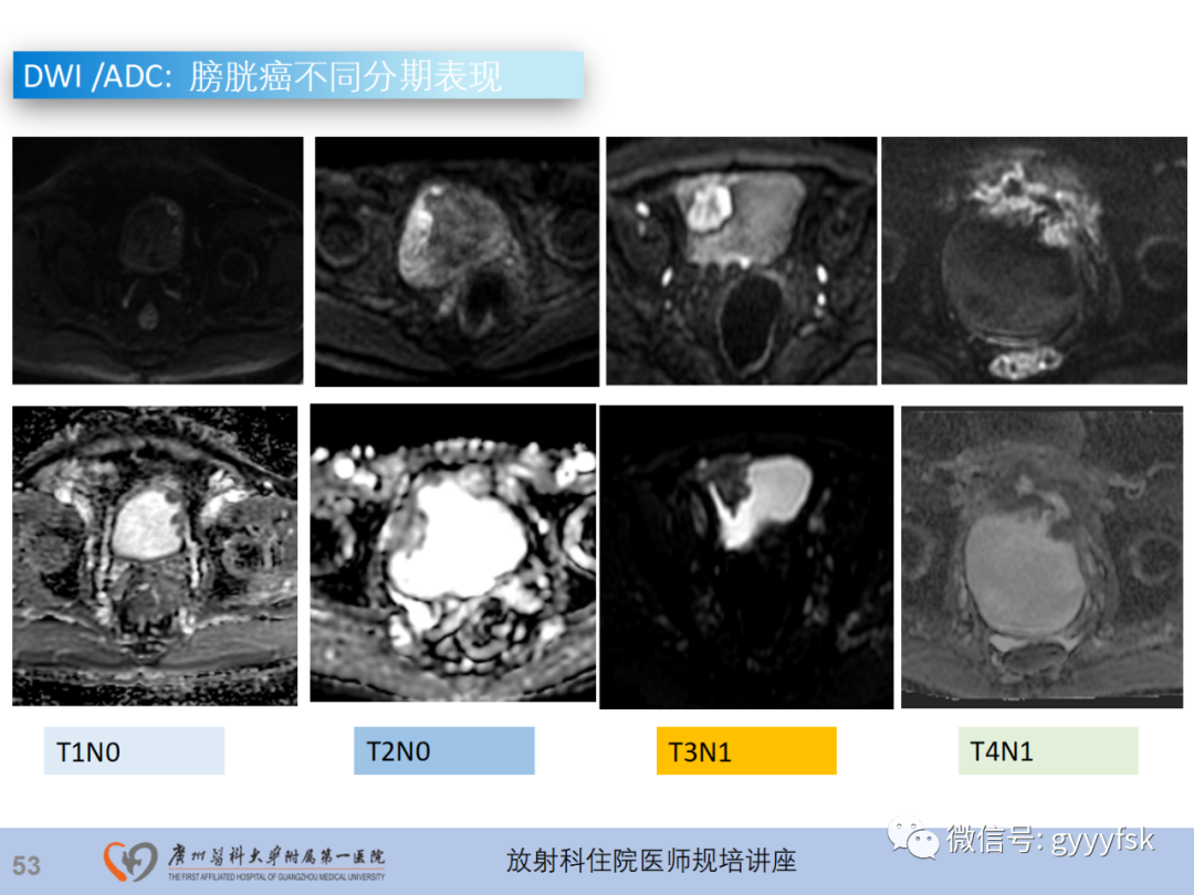 影像PPT - 【PPT】膀胱癌影像诊断、分期及鉴别诊断-54