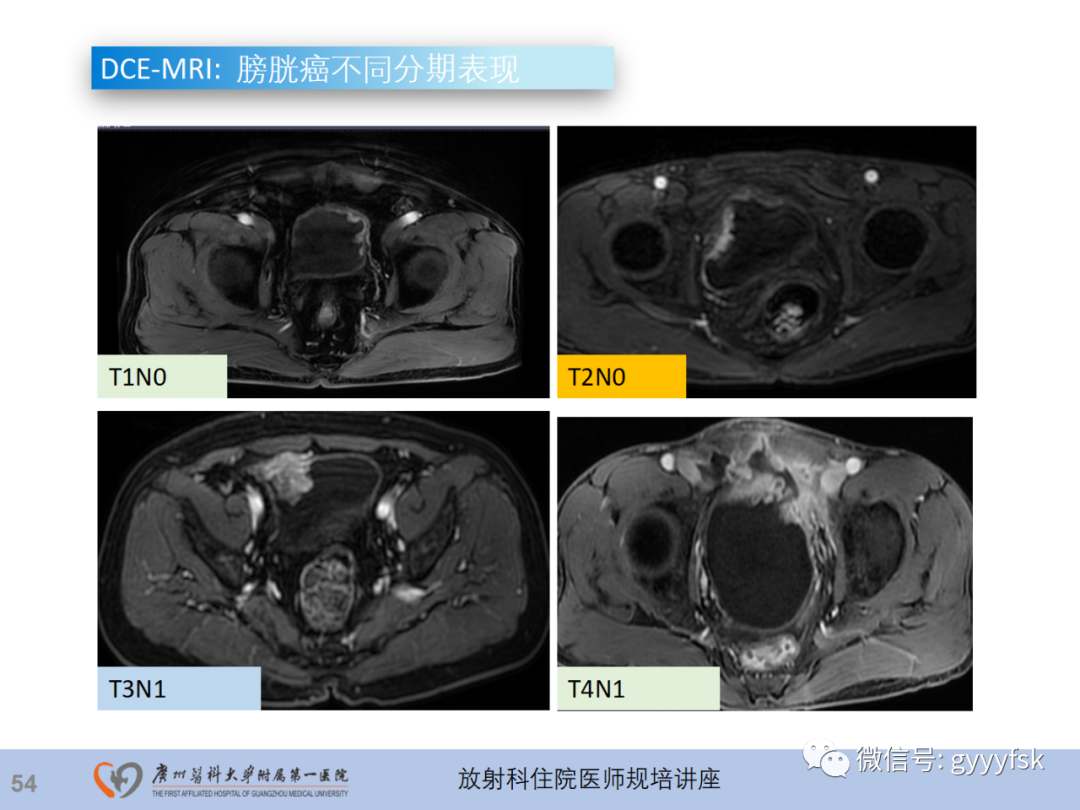 影像PPT - 【PPT】膀胱癌影像诊断、分期及鉴别诊断-55