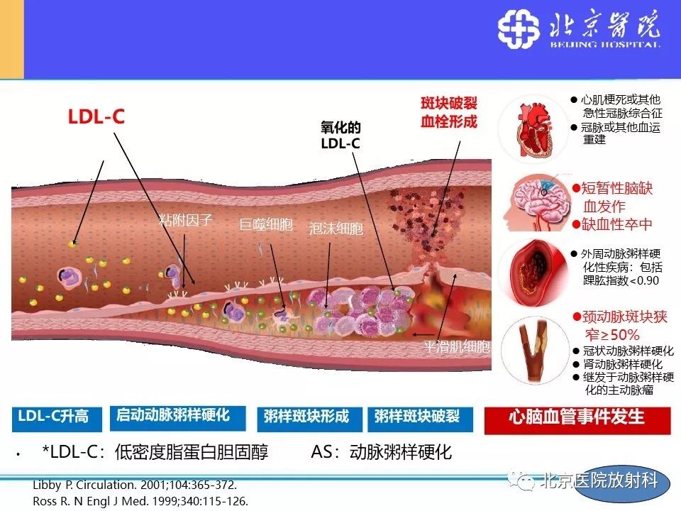 影像PPT - 【PPT】HRMRI在缺血性脑卒中精准病因诊断中的应用-4