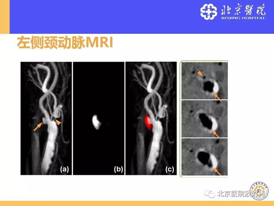 影像PPT - 【PPT】HRMRI在缺血性脑卒中精准病因诊断中的应用-7