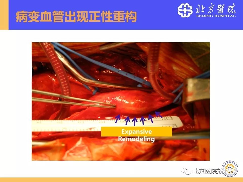 影像PPT - 【PPT】HRMRI在缺血性脑卒中精准病因诊断中的应用-8