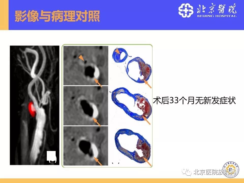 影像PPT - 【PPT】HRMRI在缺血性脑卒中精准病因诊断中的应用-9
